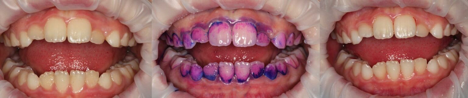 Drei Nahaufnahmen von geöffnetem Mund mit sichtbaren Zähnen, mittleres Bild zeigt Zähne mit violettem Färbemittel zur Plaqueanzeige.