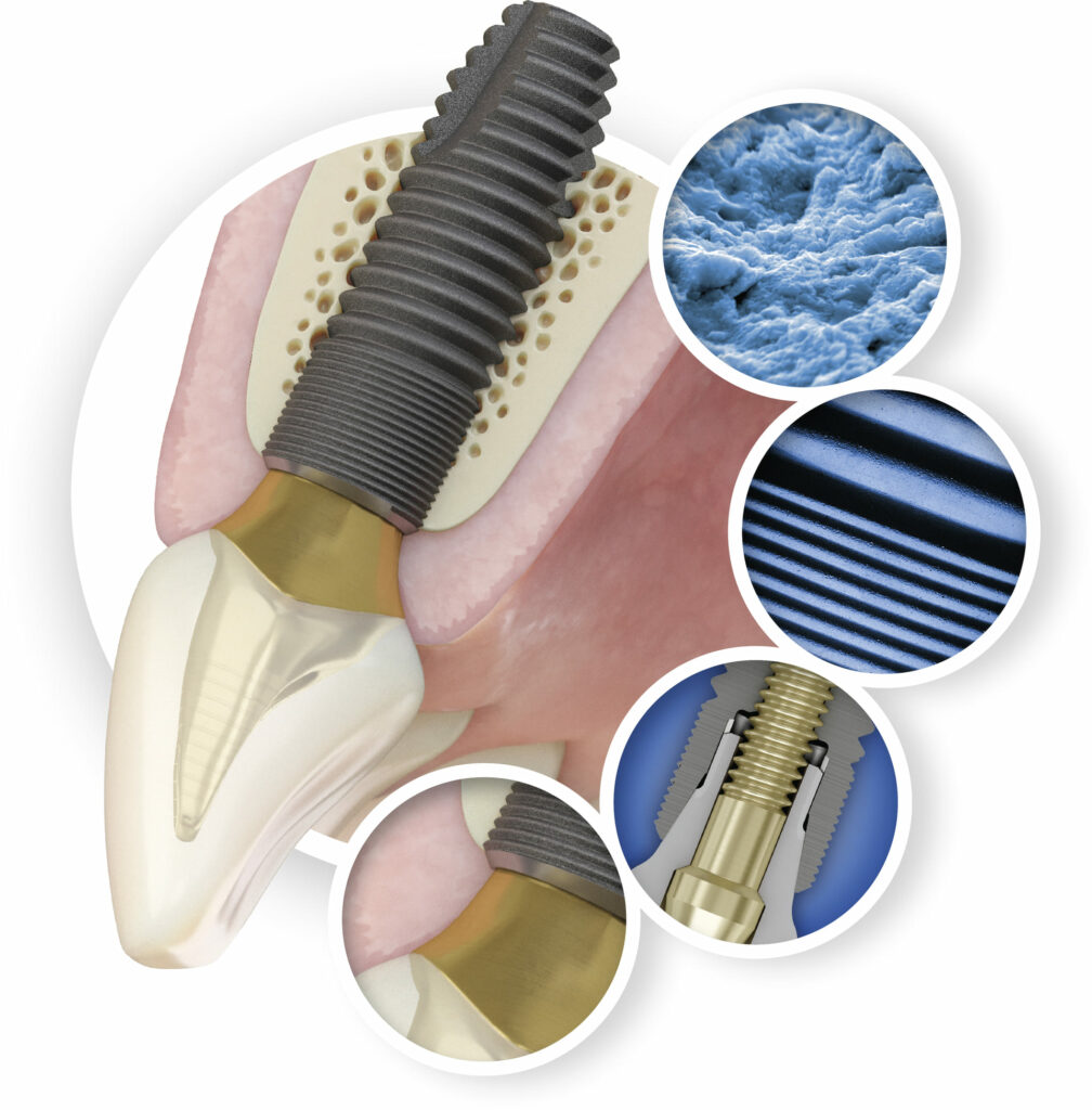 Zahnimplantat mit Schraube im Kieferknochen, umgeben von drei Detailansichten: Oberflächenstruktur, feine Linien und Implantatverbindung.
