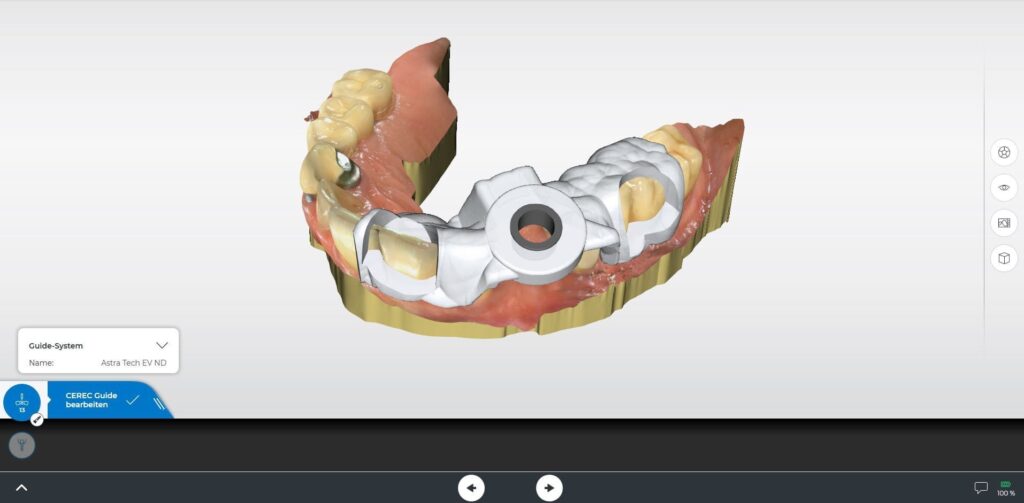 3D-Modell eines Zahnfleischs mit Zahnimplantaten und einer Bohrschablone aus Metall und Kunststoff in verschiedenen Farben