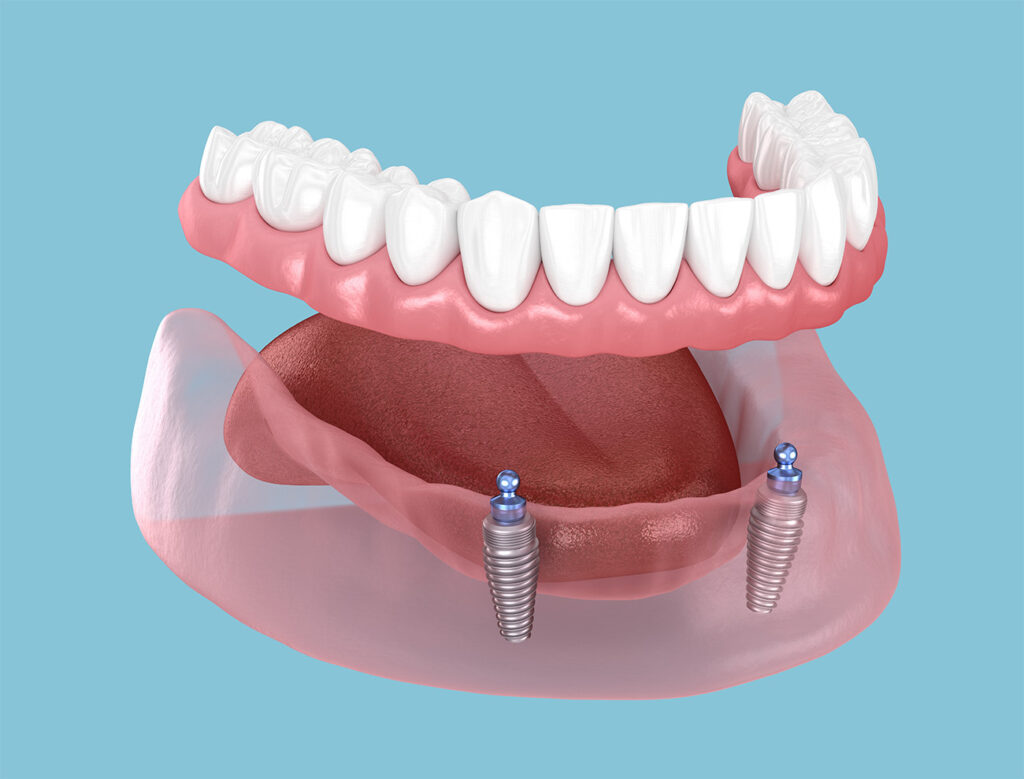 Unterkiefer mit zwei Implantaten und darauf sitzender implantatgetragener Totalprothese